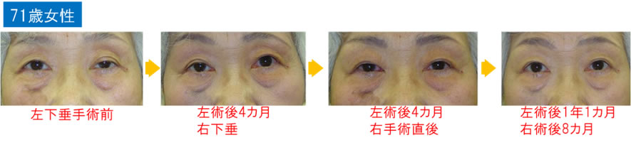 当院で手術を受けた代表症例71歳女性