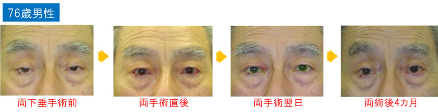 当院で手術を受けた代表症例76歳男性