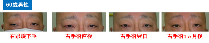 当院で手術を受けた代表症例60歳男性