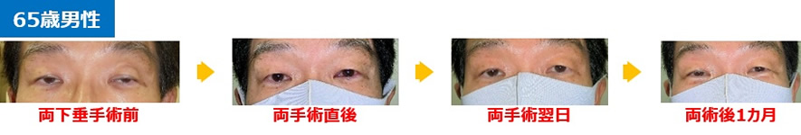 当院で手術を受けた代表症例65歳男性