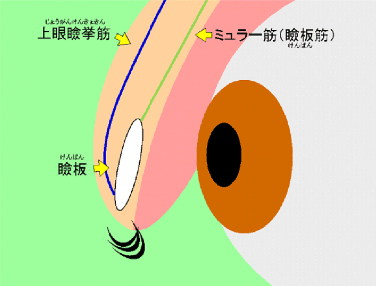 眼瞼下垂手術模式図