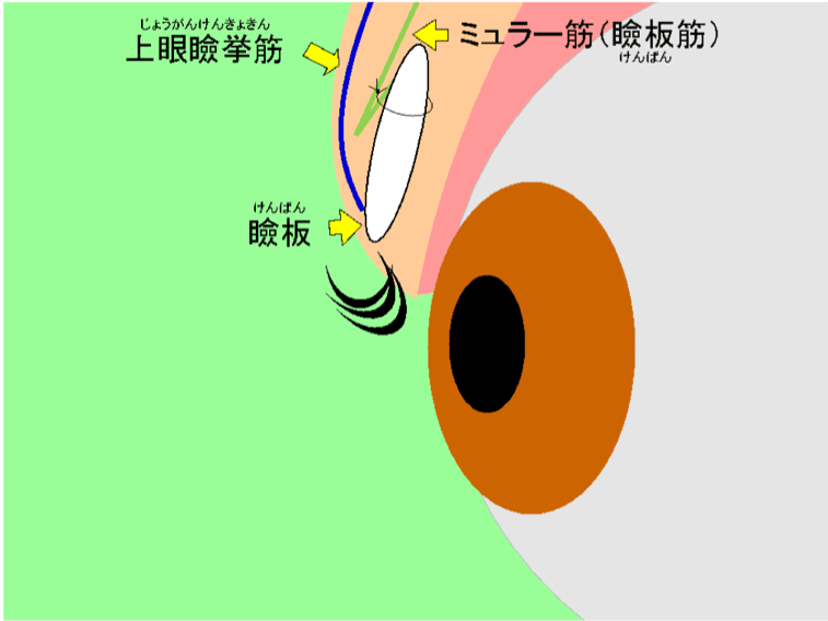眼瞼下垂手術模式図